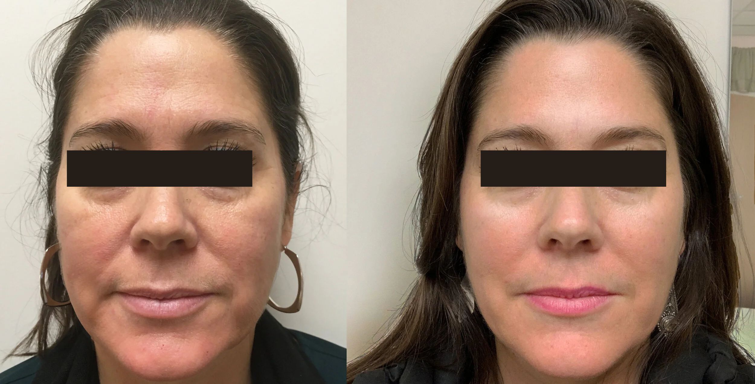 Aculifting Avant Après